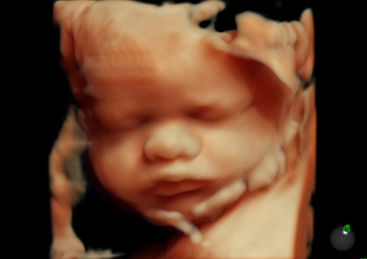 3D 4D Sonography 