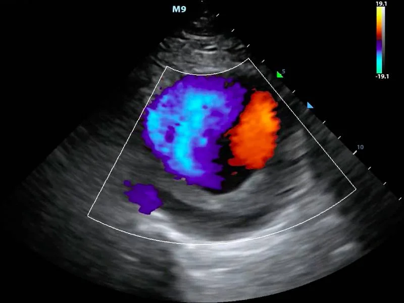 Colour Doppler Study 
