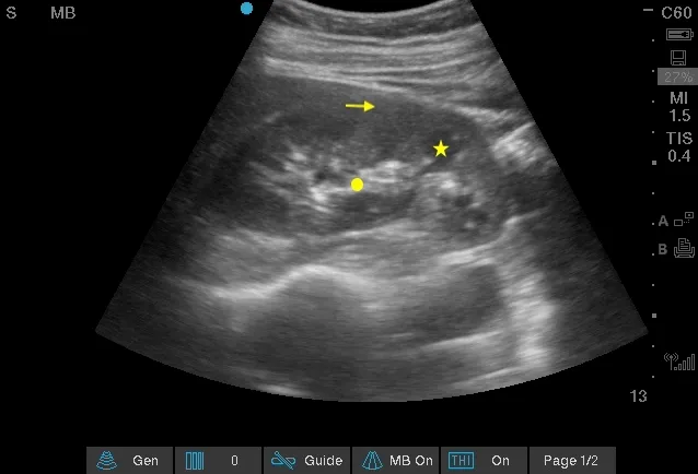 Kidney & Urinary Tract Ultrasound 