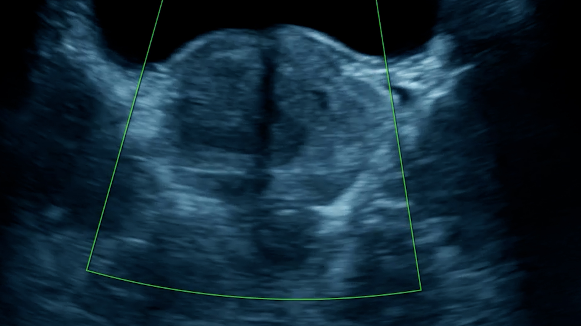 Male Pelvis / Prostate Ultrasound 