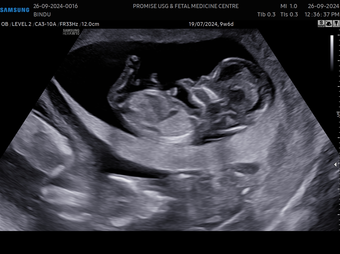 NT / Anomaly Scan 